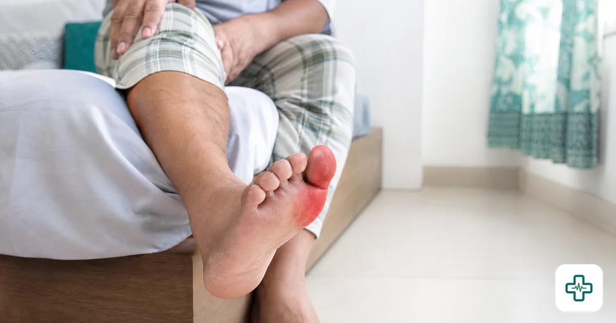A photorealistic close-up of a red, swollen, inflamed big toe joint of a person sitting on a bed, suggesting a painful gout attack