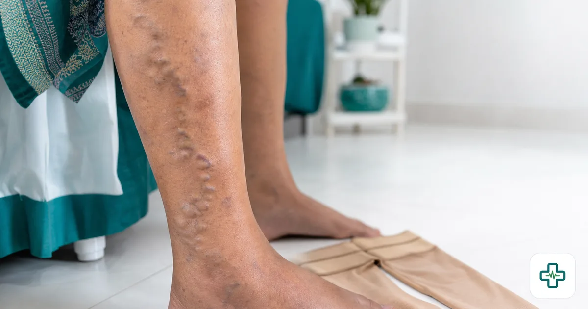 Close-up of a person's lower legs showing twisted bluish varicose veins on the calf, with compression stockings resting nearby
